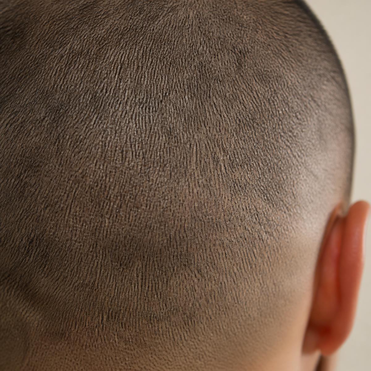 Transplant scar concealed with follicle stipple.